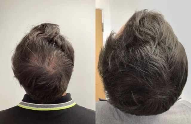 https://multimedica.pl/wp-content/uploads/2024/10/Non-Surgical-Hair-Treatment-Before-And-After-640x416.webp